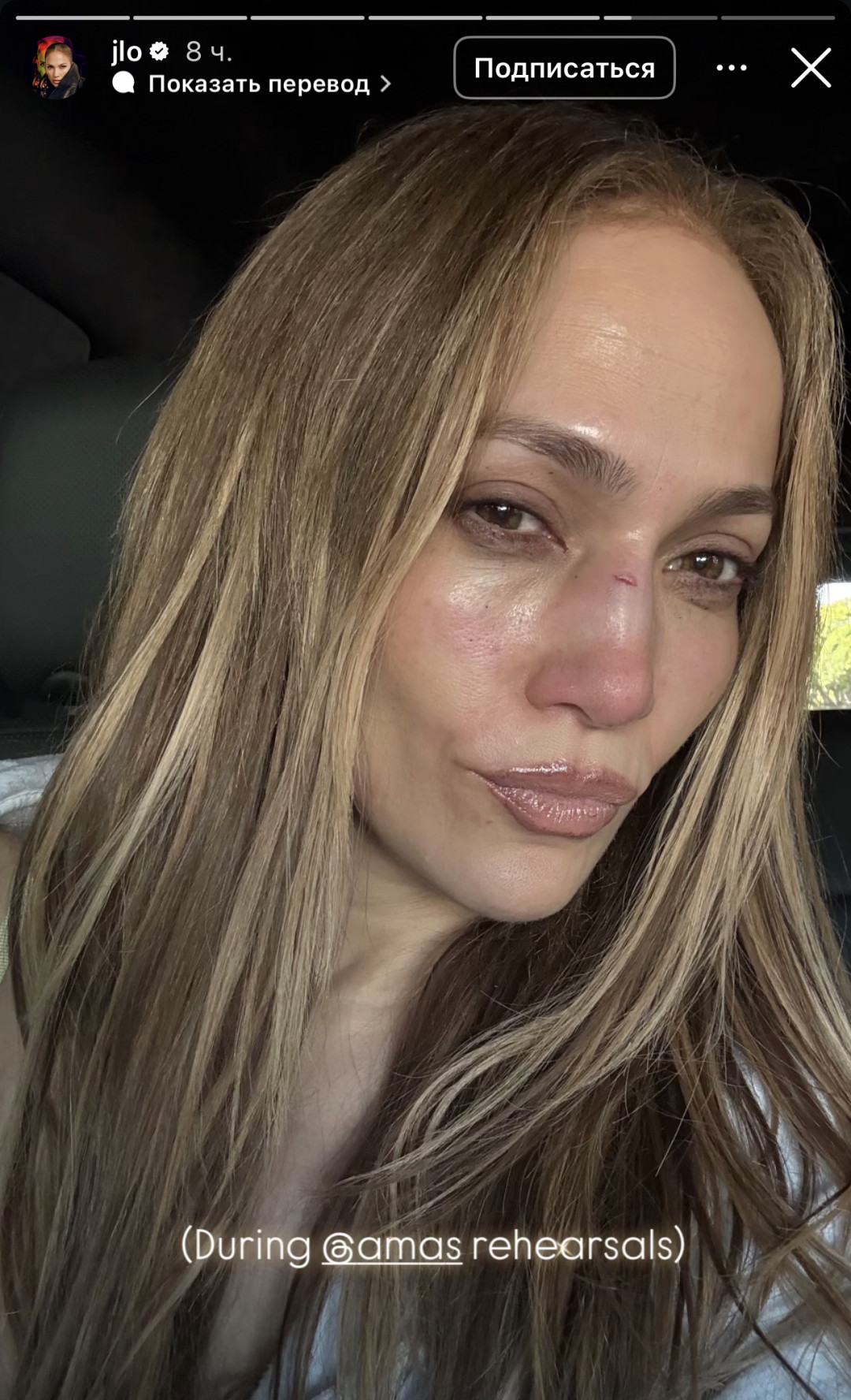 Дженнифер Лопес получила травму лица